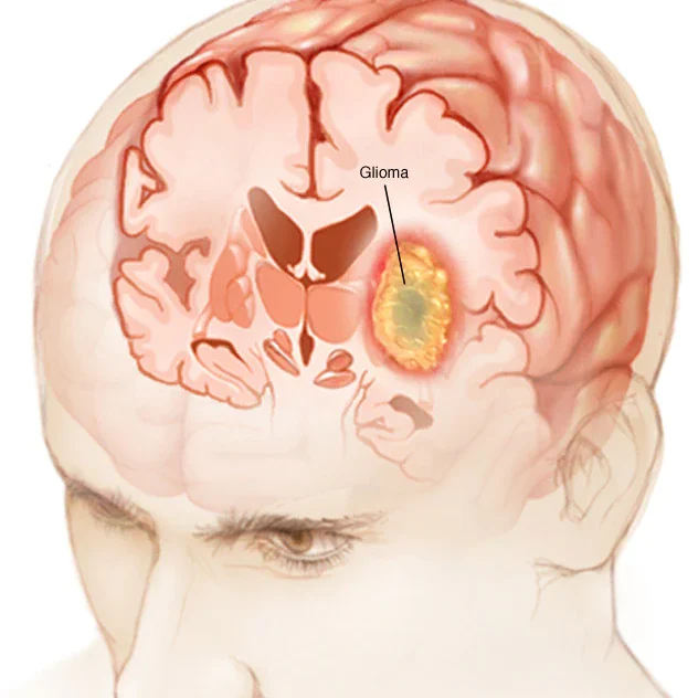 CHARM: A Rapid Brain Tumor Analysis With AI mcdc7 glioma 8col edited glioma
