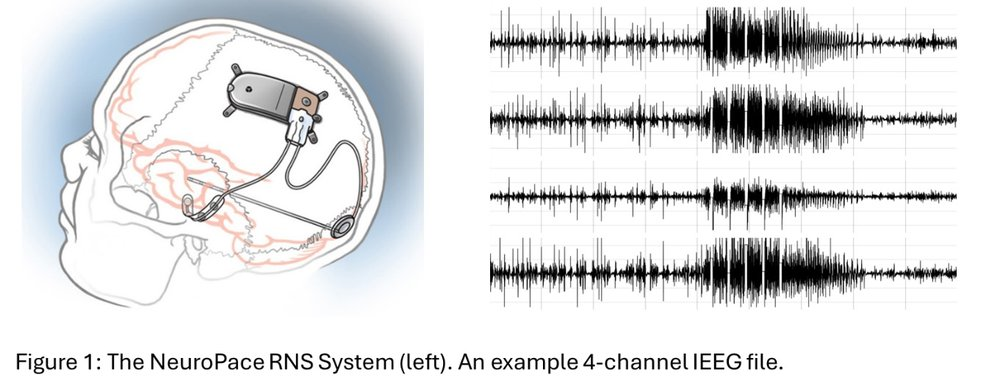 The NeuroPace RNS System (left). An example 4-channel IEEG file