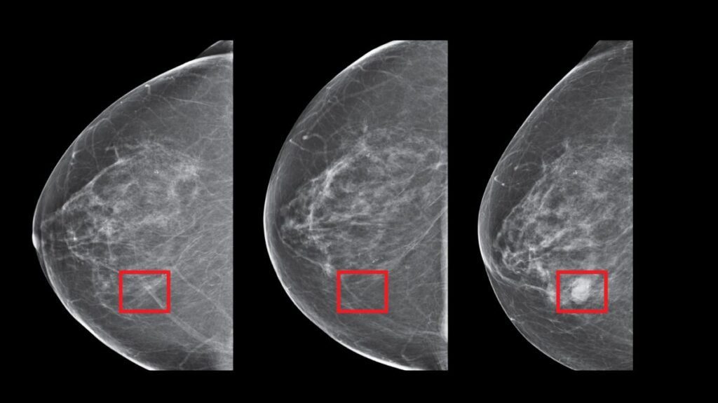 SimBioSys AI 3D Visualizations In Breast Cancer Detection Breast cancer Breast cancer